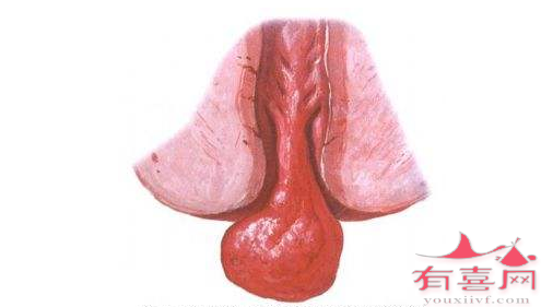 惠州助孕机构信息：宫颈息肉影响月经吗？(图1)